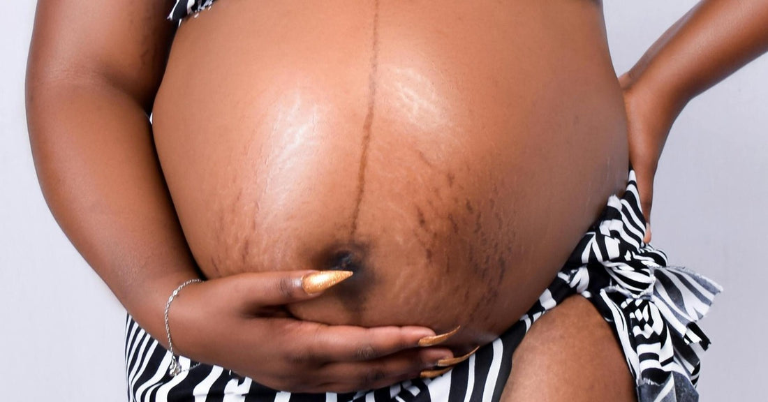 Femme enceinte qui porte les marques de son parcours avec des vergetures de grossesse